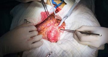 aneurysm aortic abdominal artery jha